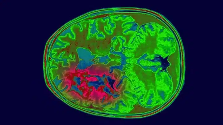 weed glioma cells