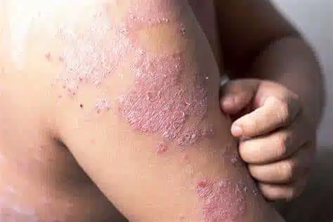 Psoriasis